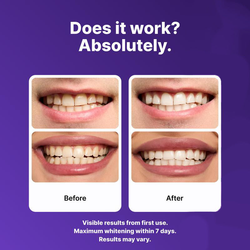 🎄 Christmas Special! AQA Teeth Whitening Strips - 21 Treatments | Safe for Enamel & Sensitive Teeth | 50% OFF（副本）